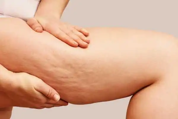 Image of woman showing leg with cellulite Stony Stratford