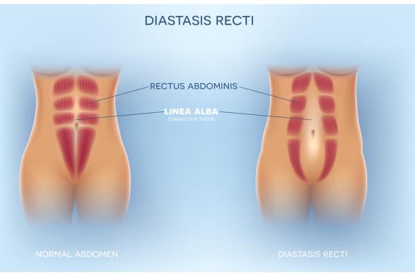 What Non-Surgical Options Are Available for Diastasis Recti Stony Stratford?