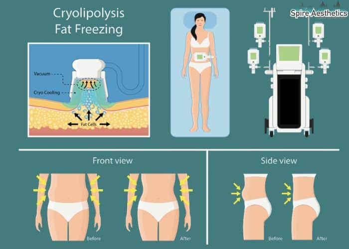 Image of diet and fat freezing combined for best results for Spire Aesthetics Stony Stratford