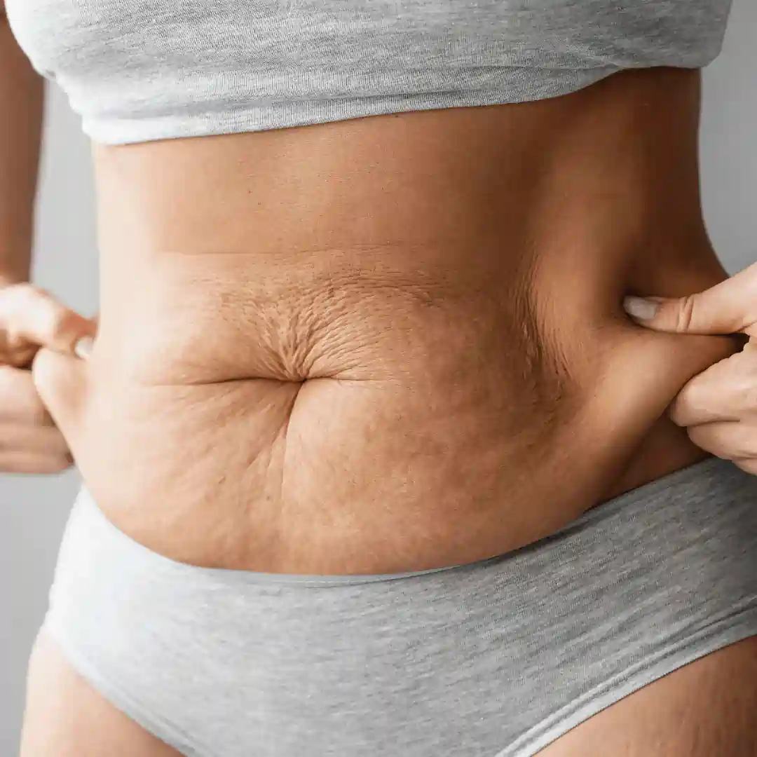 Is It Normal to Have Loose Skin After Pregnancy Stony Stratford?
