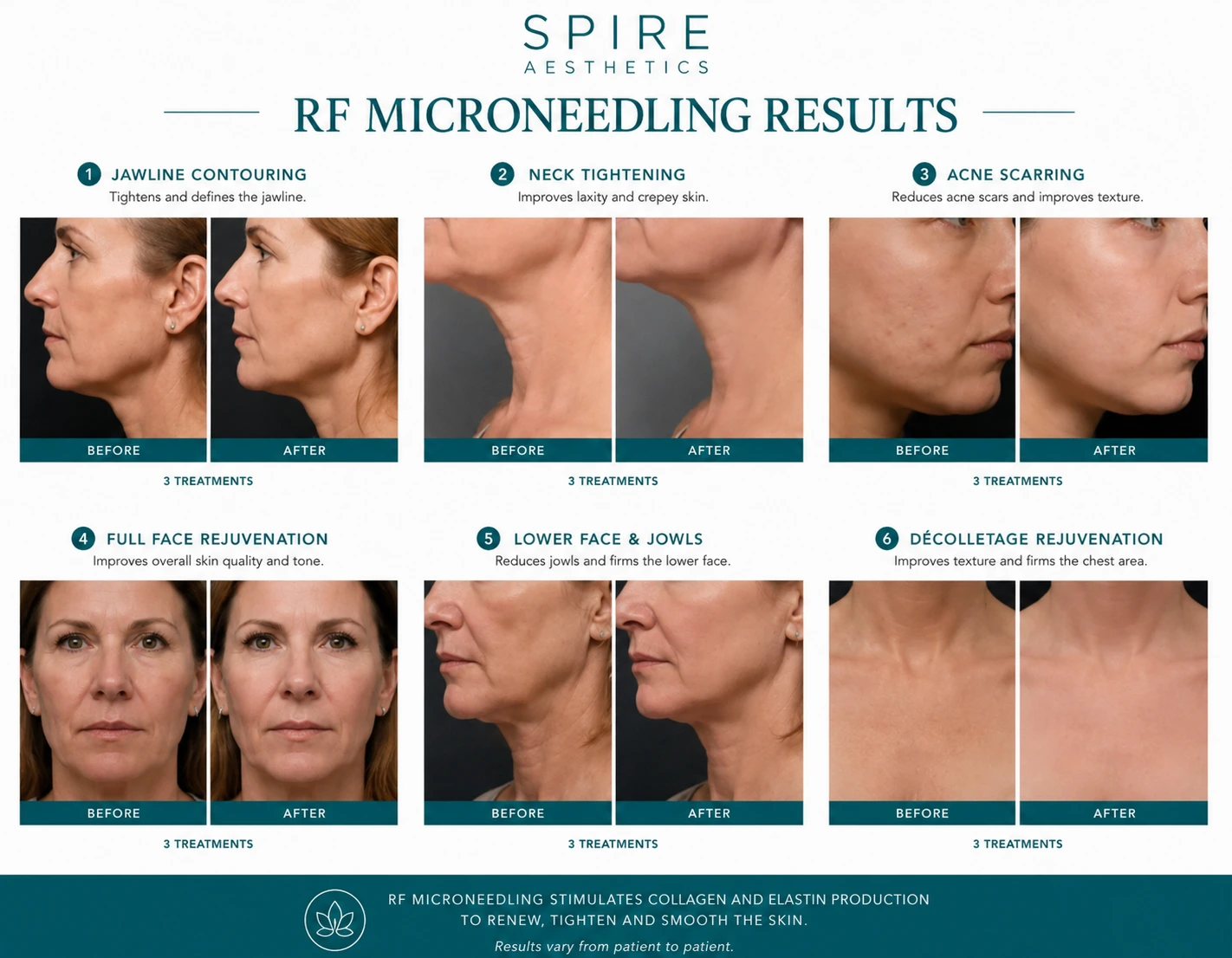 RF Microneedling Skin tightening Stony Stratford results