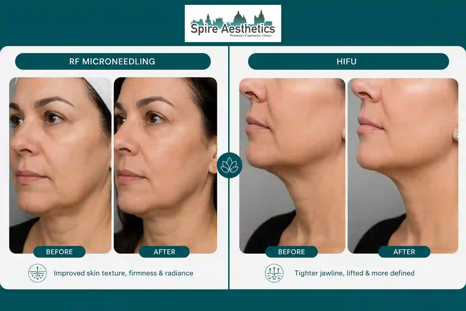 Can RF Microneedling and HIFU Be Combined Stony Stratford?