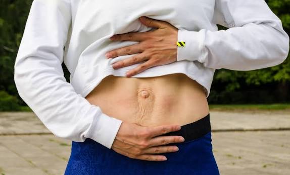 When Could Diastasis Recti Be the Missing Piece of the Puzzle Stony Stratford?