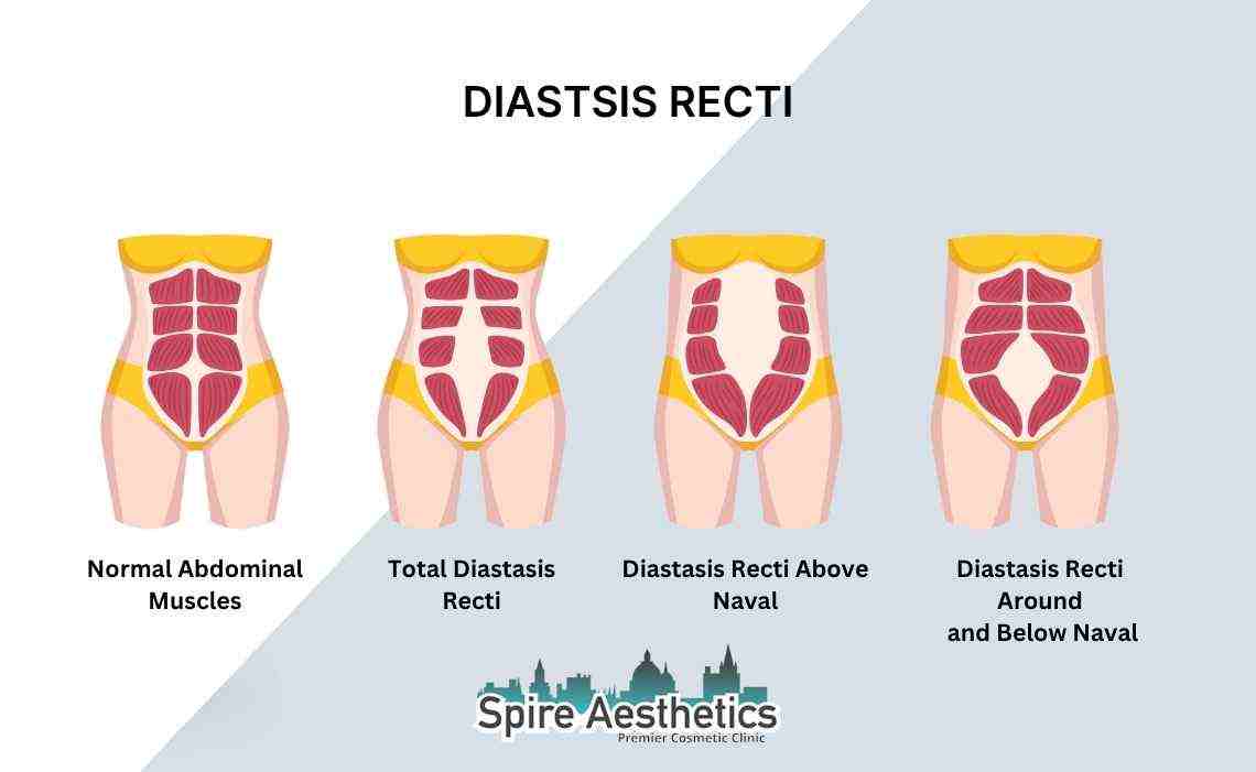 Is Non-Surgical Diastasis Recti Treatment Right for You? Common Concerns Answered Stony Stratford